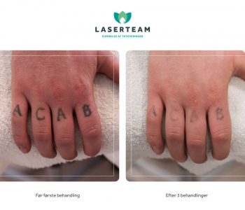 Tatoveringsfjernelse af tatovering på hænder