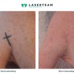 Fjernelse af tatovering på hånd