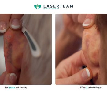 Fjernelse af tatovering på øre med laser