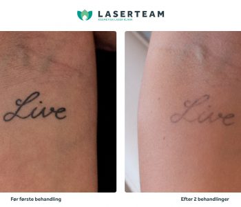 Male tale Om indstilling Tatoveringsfjernelse med laser · Professionel fjernelse af tatoveringer
