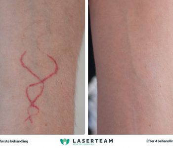 Tatoveringsfjernelse af rød og sort blæk