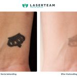 Laserbehandling af tatovering på håndled
