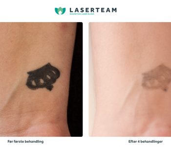 Laserbehandling af tatovering på håndled