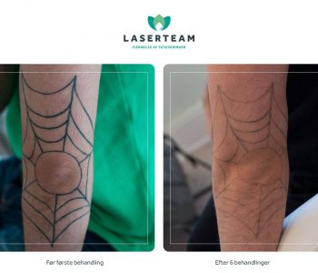 Fjernelse af tatovering på albue