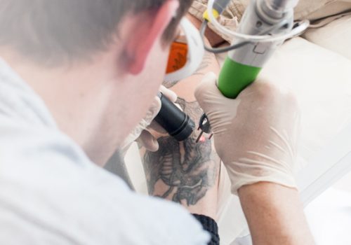 Tatoveringsfjernelse