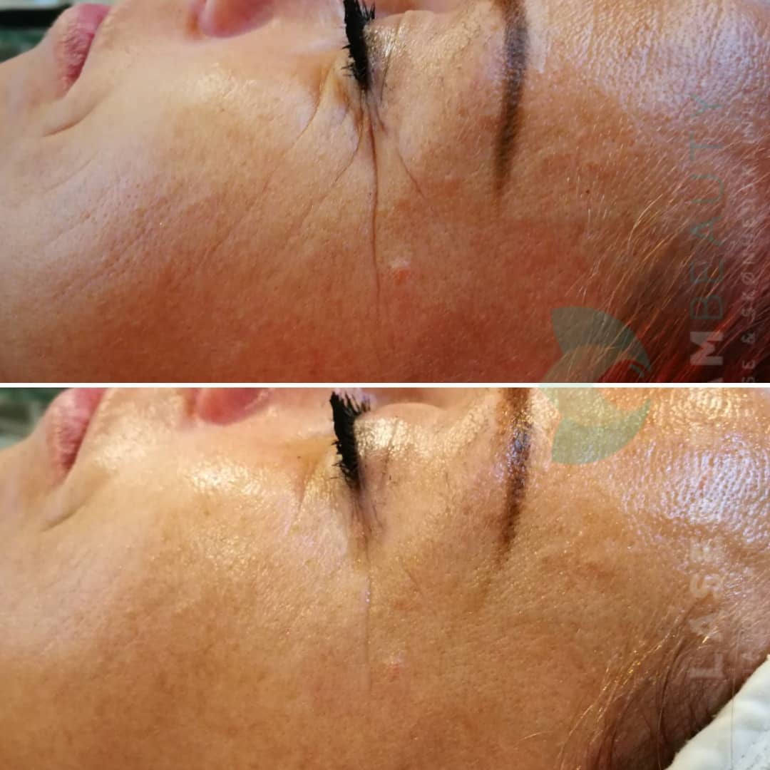 Meso Boost Up behandling på upasset hud