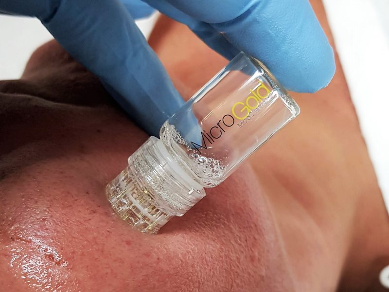 MicroGold Microchanneling